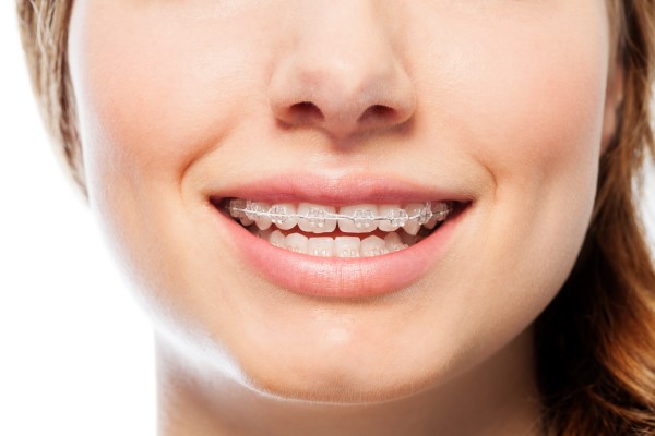 Popular Options For Aesthetic Braces