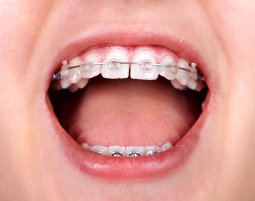 Benefits Of Early Orthodontic Treatment