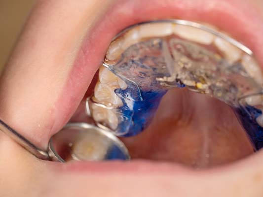 Adjusting To A Palatal Expander